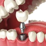 implant dentar