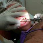 anestezia dentară