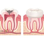 Tratament endodontic