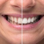 whitening treatment