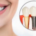 Dental implant