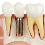implant dentar
