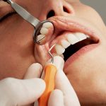 Photo fluoridation at home