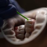 Photo dentar indepartare